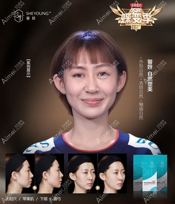 亚韩馨妍玻尿酸填充太阳穴、苹果肌、下颏、眉弓案例 亚韩馨妍玻尿酸填充太阳穴、苹果肌、下颏、眉弓案例