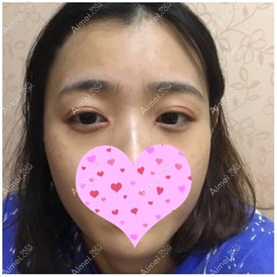 双眼皮术后15天 双眼皮术后15天