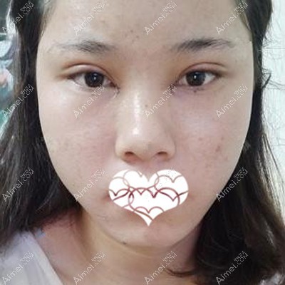 在玉林华美做完眼综合术后第二天肿胀感较强 在玉林华美做完眼综合术后第二天肿胀感较强