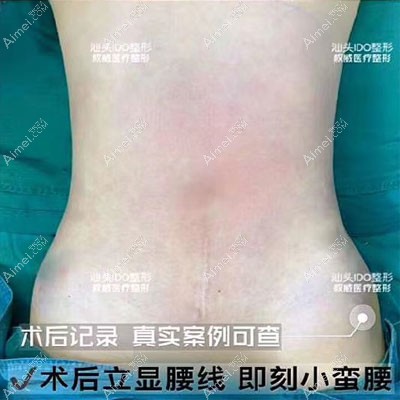 360水动力腰腹环吸术后效果图 360水动力腰腹环吸术后效果图