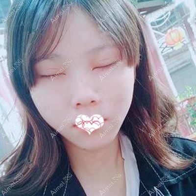 在玉林华美做眼综合术后闭眼看痕迹不是很明显 在玉林华美做眼综合术后闭眼看痕迹不是很明显