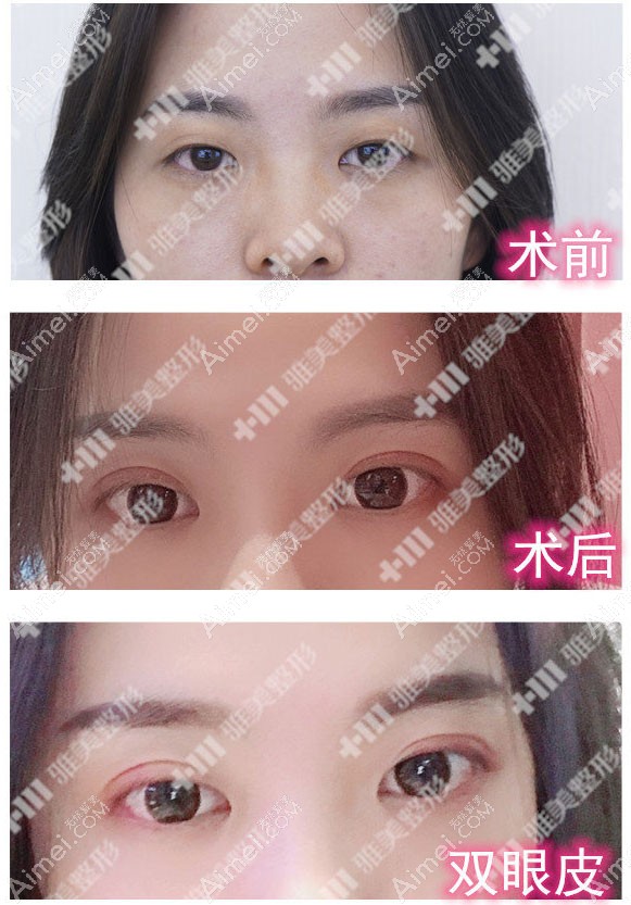 皮肤松弛型肿泡眼：去皮+切开双眼皮