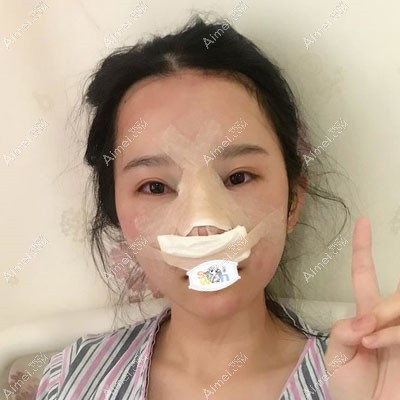 韩士生科假体隆鼻+耳软骨垫鼻尖真人案例 韩士生科假体隆鼻+耳软骨垫鼻尖真人案例