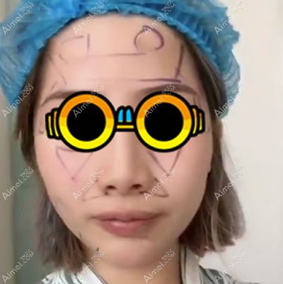 面部凹陷做全脸脂肪填充手术前 面部凹陷做全脸脂肪填充手术前