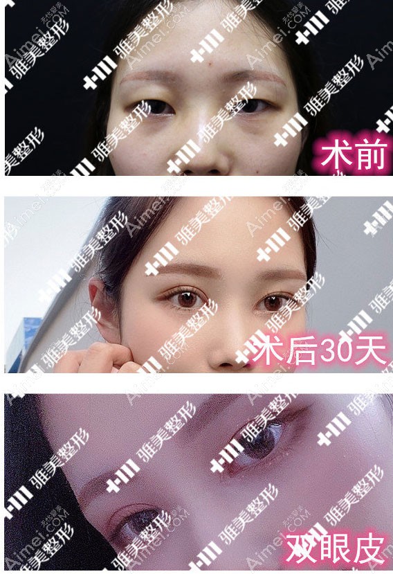 脂肪型肿眼泡：眼部吸脂+切开双眼皮