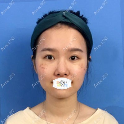 汕头曙光假体隆鼻真人案例术前效果图 汕头曙光假体隆鼻真人案例术前效果图