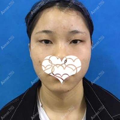做眼综合术前是肿泡眼 做眼综合术前是肿泡眼