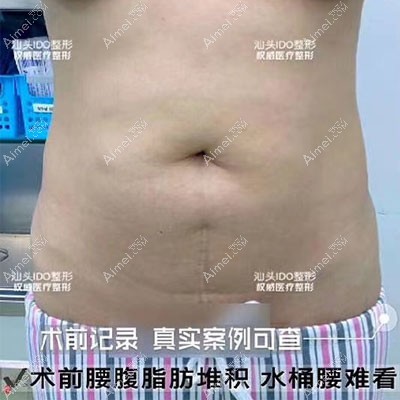 汕头爱都沪美人腰腹吸脂案例 汕头爱都沪美人腰腹吸脂案例