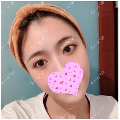 双眼皮术后90天 双眼皮术后90天