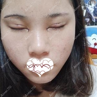 在玉林华美做完眼综合术后第二天手术痕迹明显 在玉林华美做完眼综合术后第二天手术痕迹明显