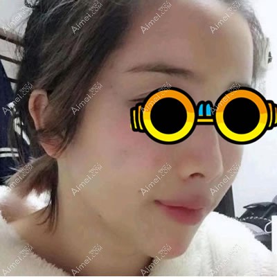 脂肪填充全脸第7天,肿胀消退了 脂肪填充全脸第7天,肿胀消退了