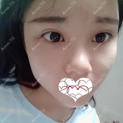 吕祖峰医生为我做眼综合术后1个月恢复差不多 吕祖峰医生为我做眼综合术后1个月恢复差不多