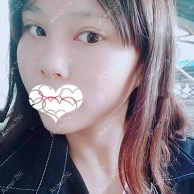 做眼综合术后15天双眼皮和眼角慢慢在恢复中 做眼综合术后15天双眼皮和眼角慢慢在恢复中