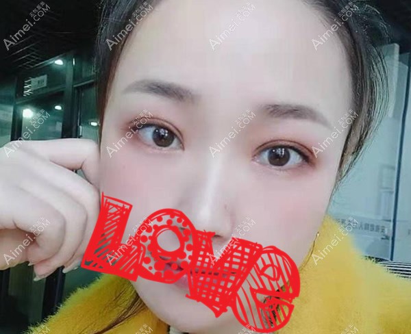 合肥壹加壹甘泉涌割双眼皮效果怎么样 合肥壹加壹甘泉涌割双眼皮效果怎么样
