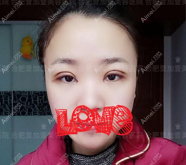 全切双眼皮第三天眼睛更肿 全切双眼皮第三天眼睛更肿