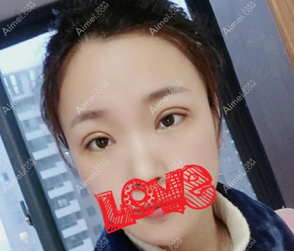 眼综合第七天拆线后 眼综合第七天拆线后