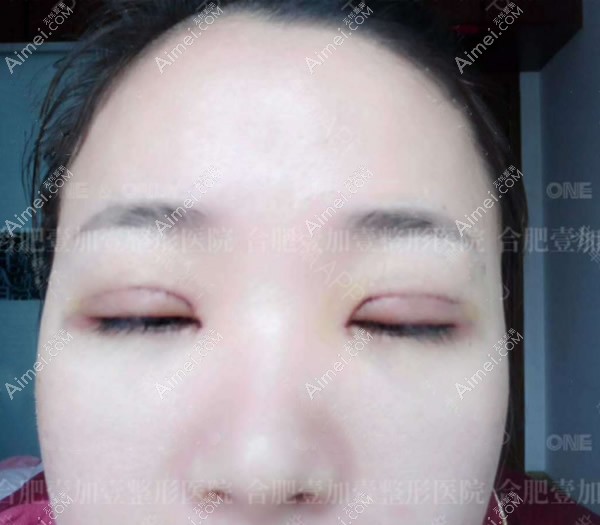 在合肥壹加壹做眼综合第1天 在合肥壹加壹做眼综合第1天