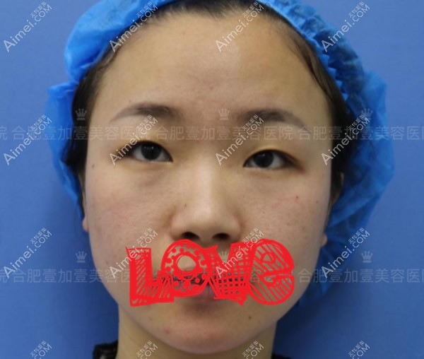我在合肥壹加壹割双眼皮前 我在合肥壹加壹割双眼皮前