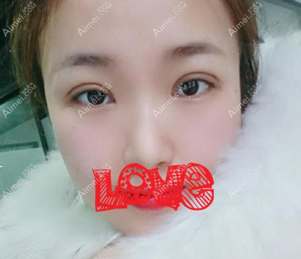 全切双眼皮一个月效果图 全切双眼皮一个月效果图