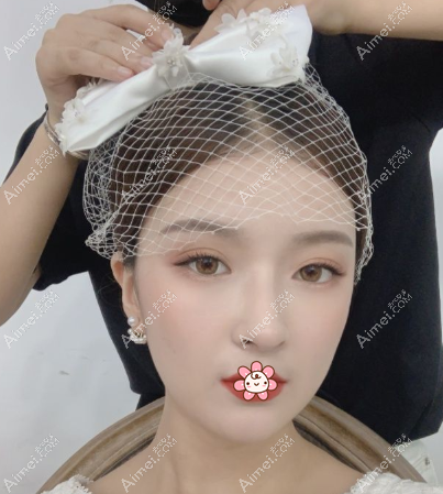 王浩宇医生祛眼袋术后3个月 王浩宇医生祛眼袋术后3个月