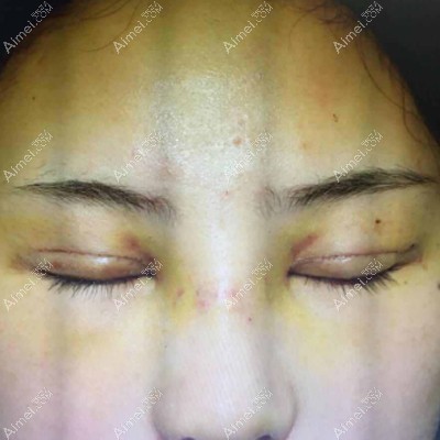 刘歆医生给我做完9毫米双眼皮5天后的恢复图片 刘歆医生给我做完9毫米双眼皮5天后的恢复图片