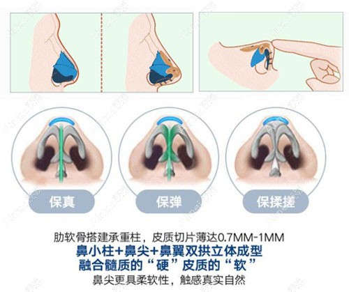 邓东伟8C骨雕隆鼻,鼻头可以揉捏 邓东伟8C骨雕隆鼻,鼻头可以揉捏