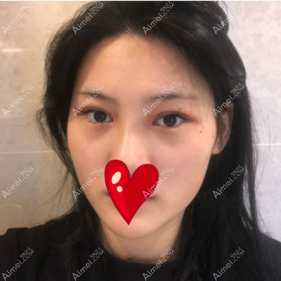刘歆医生给我做完9毫米双眼皮7天后的图片 刘歆医生给我做完9毫米双眼皮7天后的图片