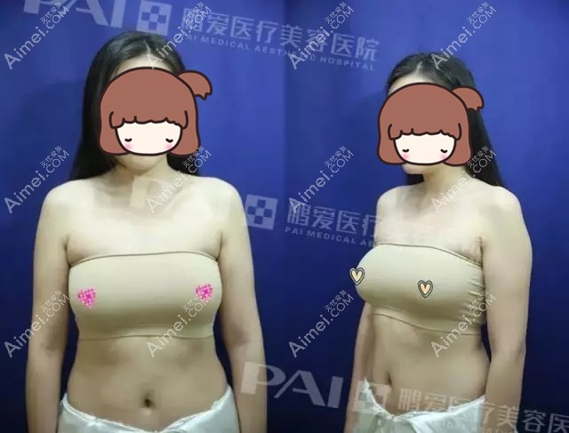 隆胸后因哺乳导致胸下垂 隆胸后因哺乳导致胸下垂