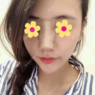 在呼市京美做完鼻综合第5天照片分享 在呼市京美做完鼻综合第5天照片分享