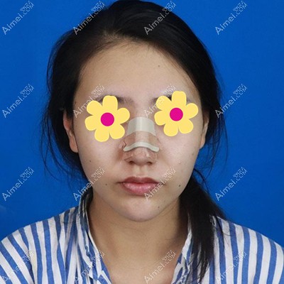马晓艳医生为我做耳软骨垫鼻尖术后8周 马晓艳医生为我做耳软骨垫鼻尖术后8周