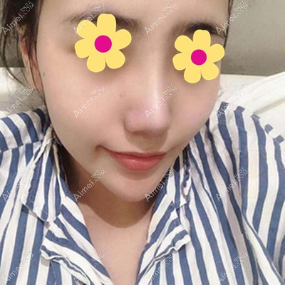 在呼和浩特做鼻部整形手术半个月了 在呼和浩特做鼻部整形手术半个月了