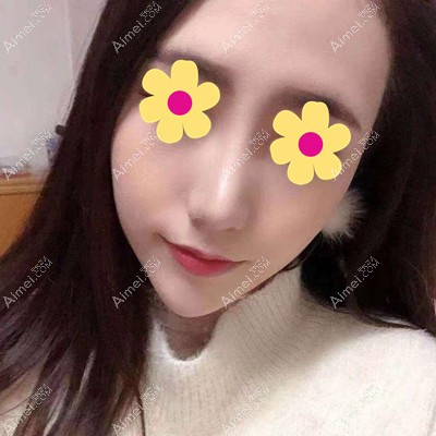 呼市京美马晓艳为我做隆鼻手术一个月了 呼市京美马晓艳为我做隆鼻手术一个月了