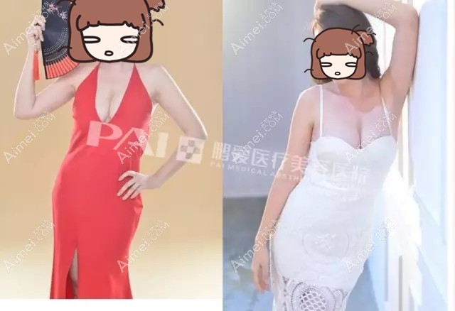 长沙鹏爱术后三个月的假体隆胸修复效果 长沙鹏爱术后三个月的假体隆胸修复效果