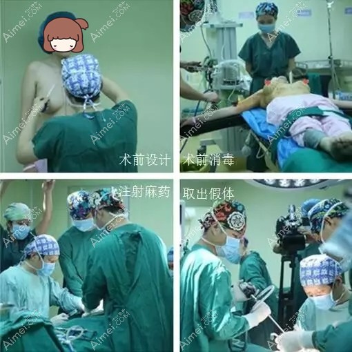 取出假体,鹏爱医生更换新的320cc的蓓拉假体手术中 取出假体,鹏爱医生更换新的320cc的蓓拉假体手术中