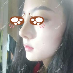 找王勇做鼻修复术后20天 找王勇做鼻修复术后20天
