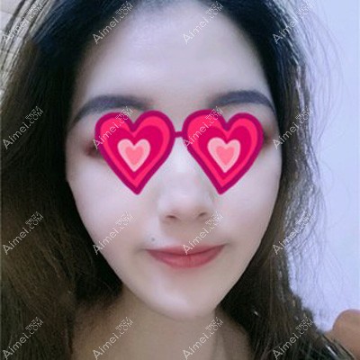面部吸脂术后60天恢复效果 面部吸脂术后60天恢复效果