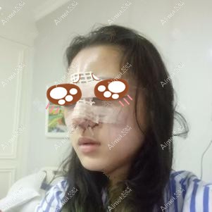 找王勇做鼻修复术后一天 找王勇做鼻修复术后一天