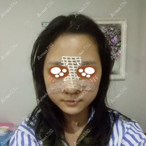 找王勇做鼻修复术后5天消肿 找王勇做鼻修复术后5天消肿