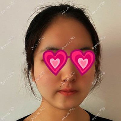 做面部吸脂前自己肉肉的脸蛋 做面部吸脂前自己肉肉的脸蛋