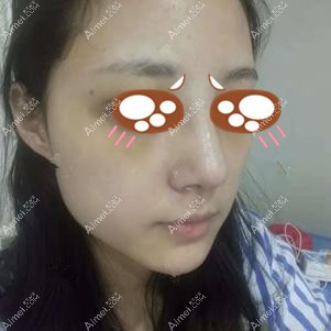 找王勇做鼻修复术后一周效果 找王勇做鼻修复术后一周效果
