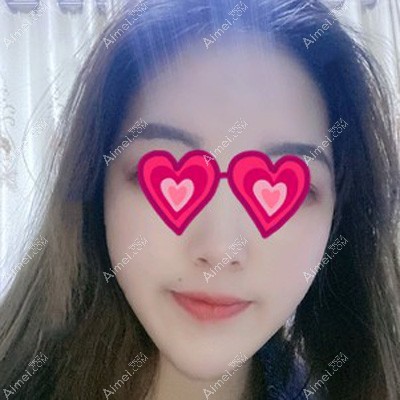 做完面部吸脂术后15天肿胀渐消 做完面部吸脂术后15天肿胀渐消