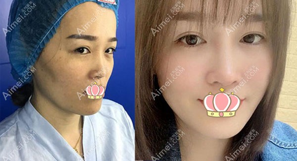 自体脂肪面部填充前后效果对比图 自体脂肪面部填充前后效果对比图