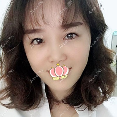 面部填充恢复过程图术后90天 面部填充恢复过程图术后90天