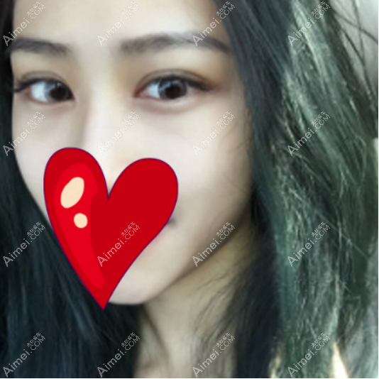 我术后恢复到80天的样子 我术后恢复到80天的样子