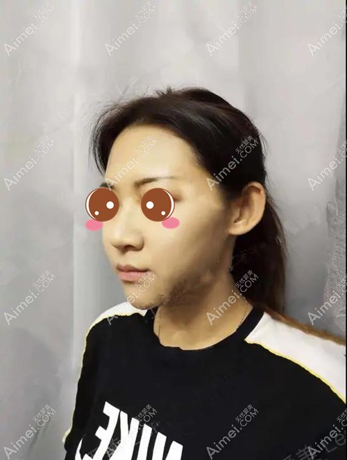 半肋骨隆鼻一个月后的图片 半肋骨隆鼻一个月后的图片
