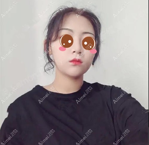 半肋骨隆鼻后会有疤痕增生期 半肋骨隆鼻后会有疤痕增生期