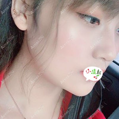 真心觉得广州广大柳超磨下颌骨价格不贵，15天消肿图片为证