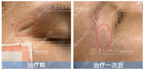 凹陷性疤痕修复一次后效果