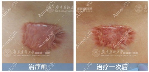 增生性疤痕修复一次后效果
