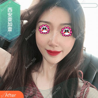 西安壹加壹面部脂肪填充术后照